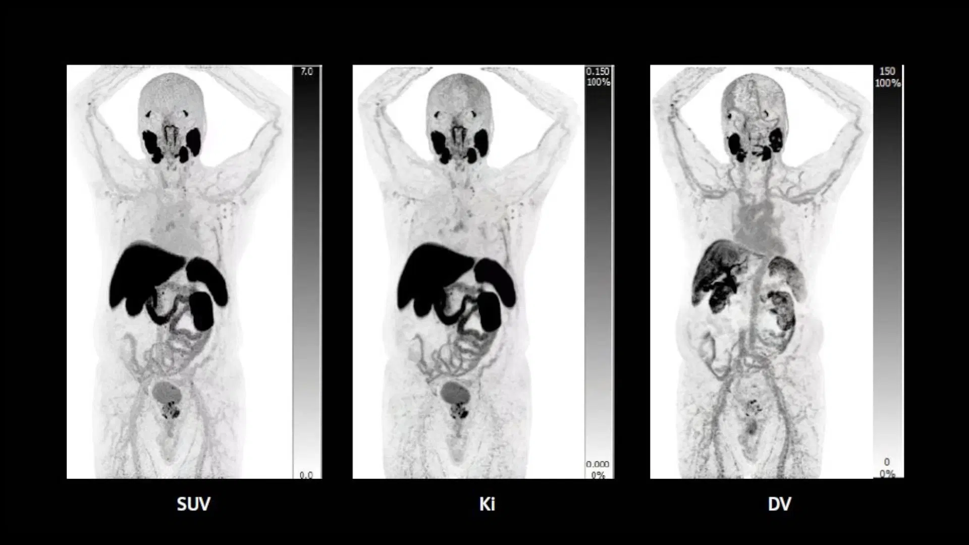 Parametric images created through kinetic modeling compared to SUV images
